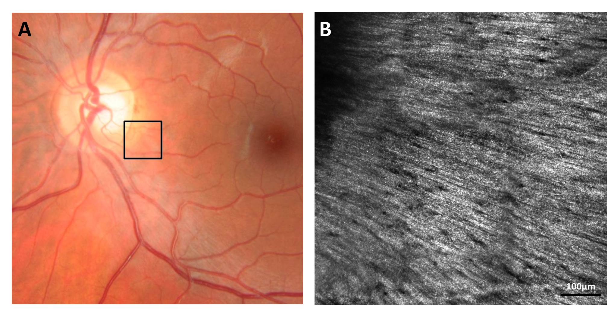 Retinal Nerve Fiber Layer - NYEE